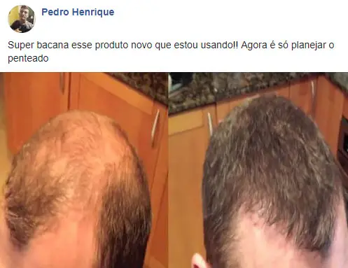 Cabelo Forte Caps antes e depois - Pedro Henrique